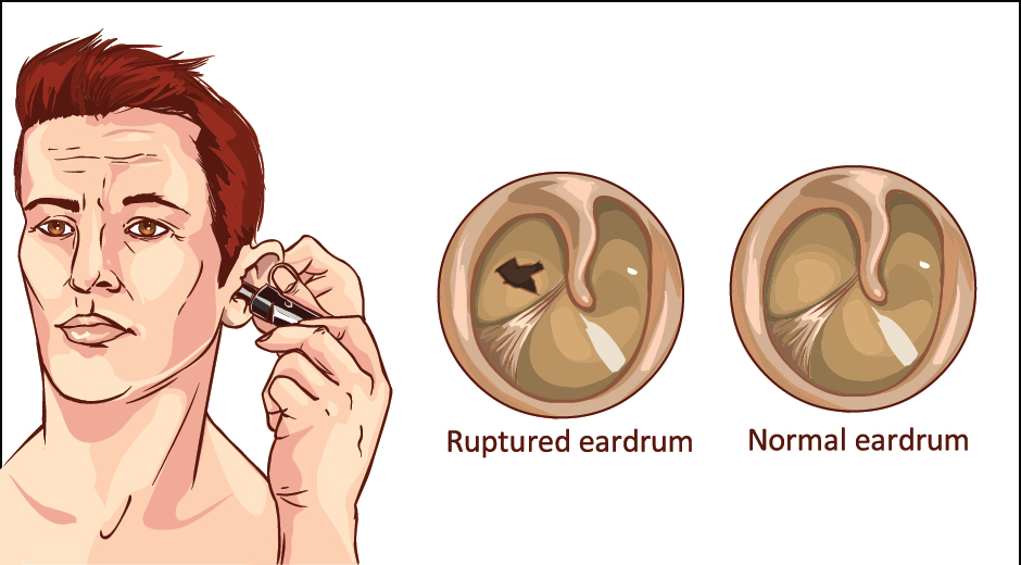 ruptured eardrum symptoms and treatment
