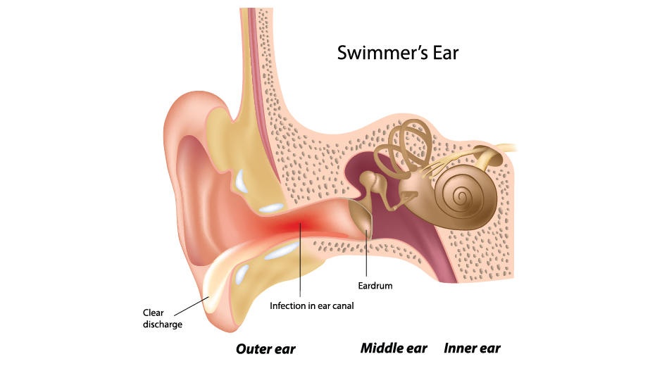 swimmers ear symptoms and treatment