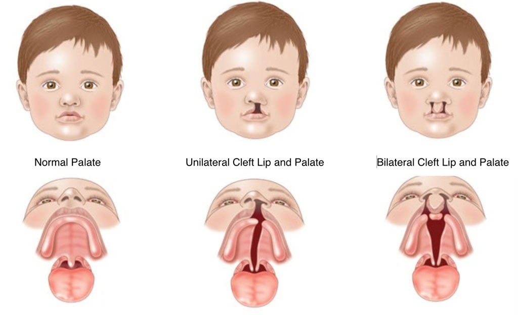 case study 101 cleft palate