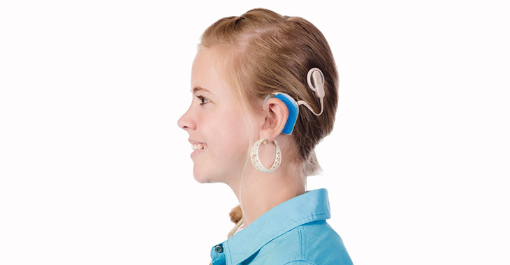 Cochlear Implant