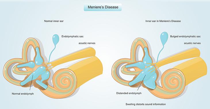 Dizziness and hearing loss