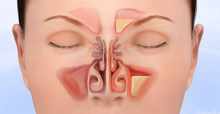 Sinusitis